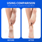 Blorfo 40% Urea Cream with 2% Salicylic Acid - Intensive Moisturizing & Exfoliating Formula for Calluses & Dry Skin - 3.52oz