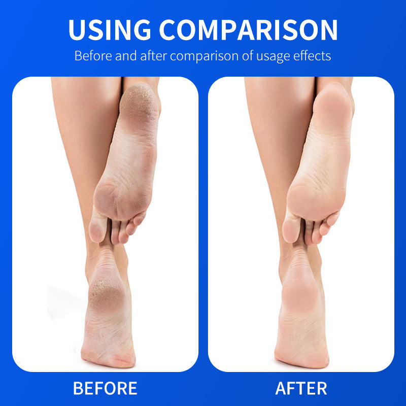 Blorfo 40% Urea Cream with 2% Salicylic Acid - Intensive Moisturizing & Exfoliating Formula for Calluses & Dry Skin - 3.52oz